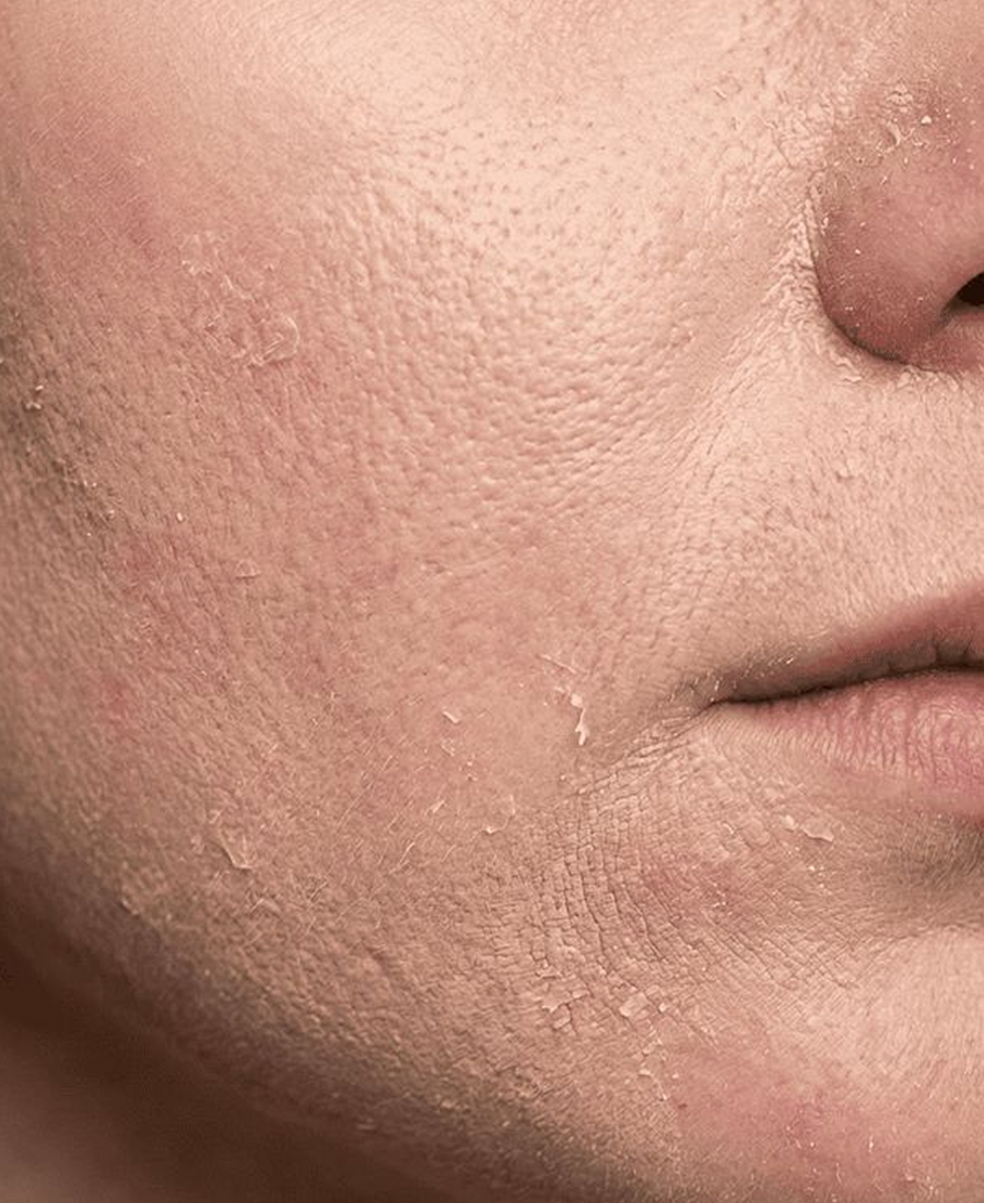 Dry or Dehydrated Skin