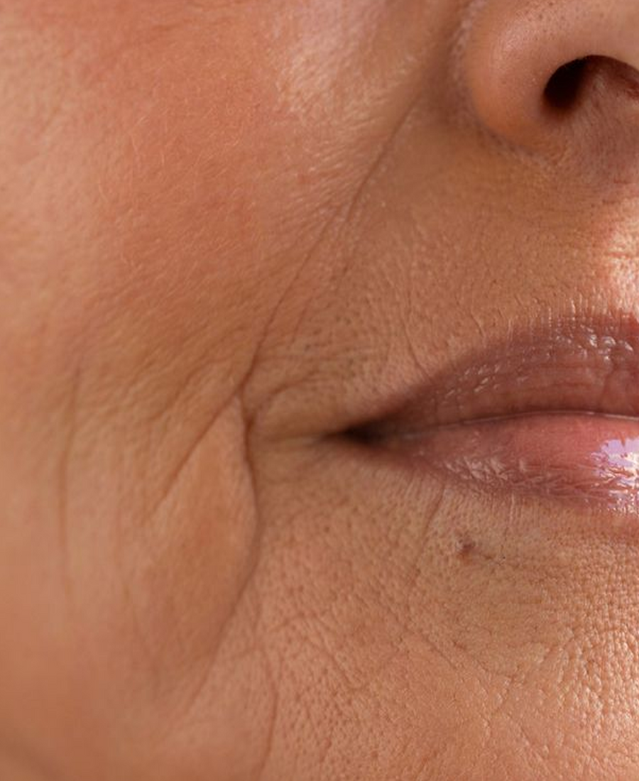 Fine Lines & Wrinkles