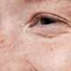 Fine Lines & Wrinkles
