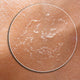 Dry or Dehydrated Skin